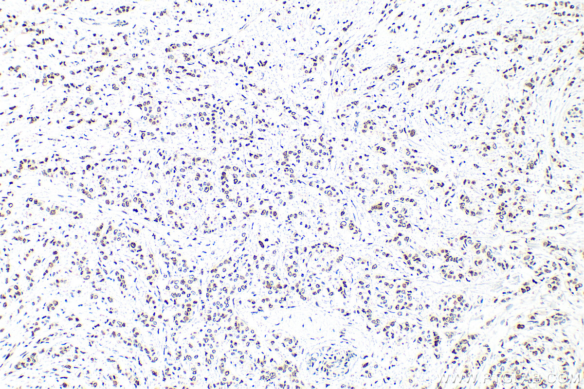 Immunohistochemistry (IHC) staining of human breast cancer tissue using PCNA Polyclonal antibody (10205-2-AP)