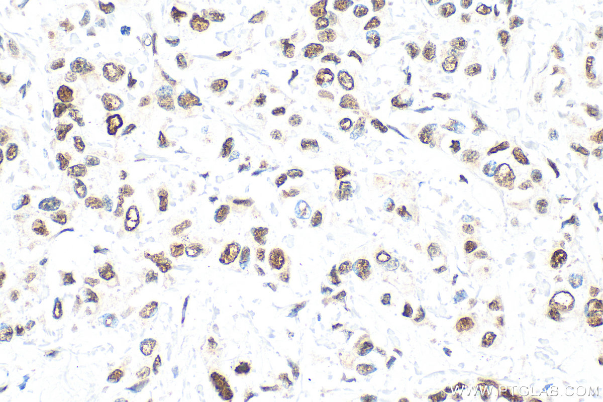 Immunohistochemistry (IHC) staining of human breast cancer tissue using PCNA Polyclonal antibody (10205-2-AP)