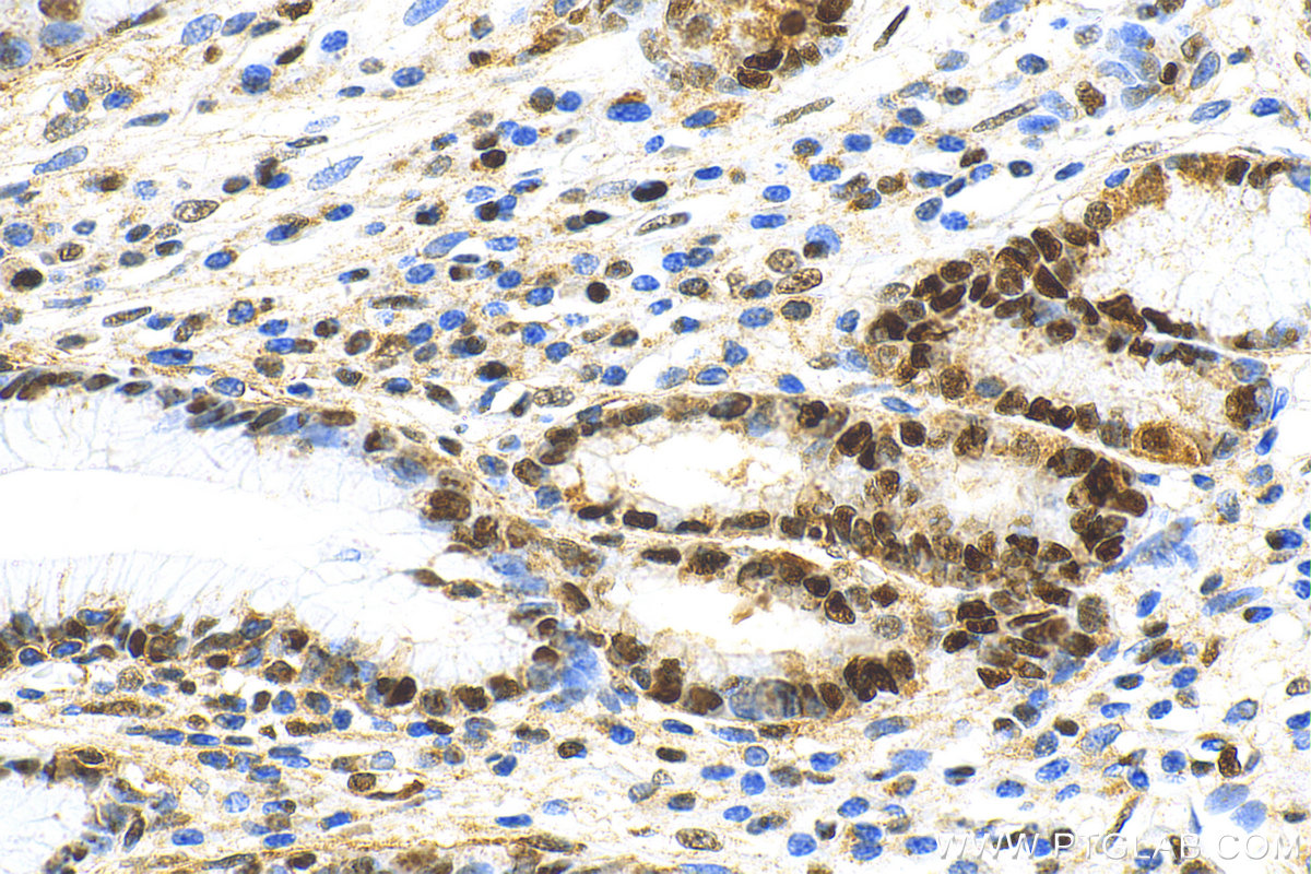 Immunohistochemistry (IHC) staining of human stomach cancer tissue using PCNA Recombinant antibody (81302-6-RR)