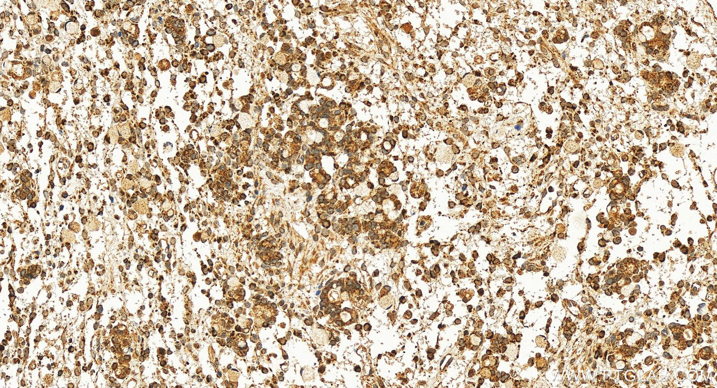 Immunohistochemistry (IHC) staining of human ovary cancer tissue using PCTAIRE3 Polyclonal antibody (12207-1-AP)