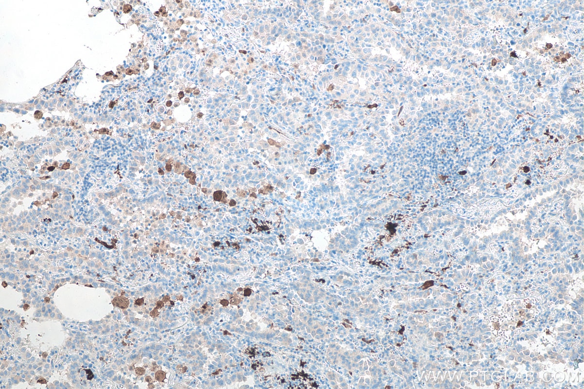 Immunohistochemistry (IHC) staining of human lung cancer tissue using PD-1/CD279 Monoclonal antibody (66220-1-Ig)