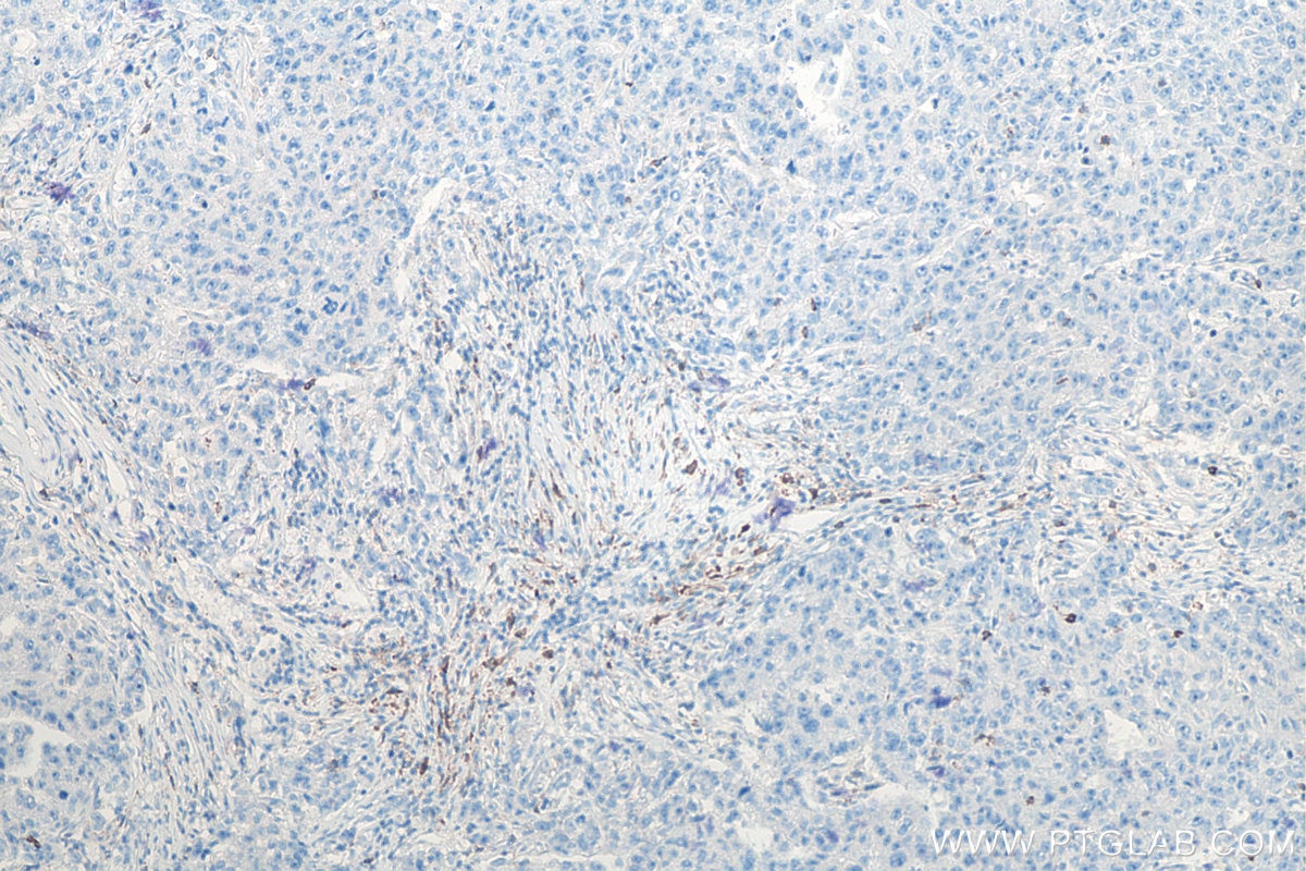 Immunohistochemistry (IHC) staining of human breast cancer tissue using PD-1/CD279 Monoclonal antibody (66220-1-Ig)