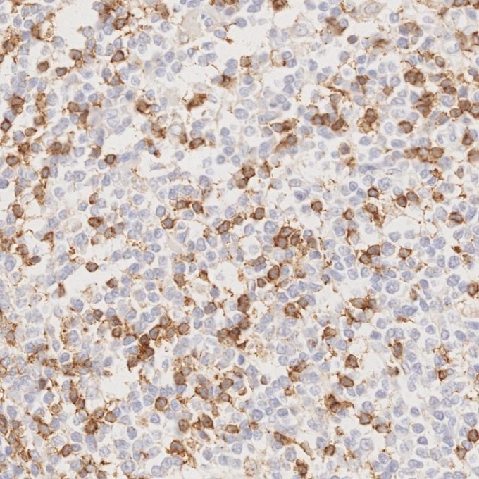 Immunohistochemistry (IHC) staining of human lymphoma tissue using PD-1/CD279 Monoclonal antibody (66220-1-Ig)