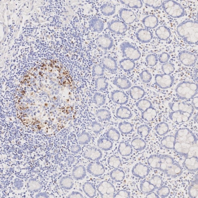 Immunohistochemistry (IHC) staining of human lymphoma tissue using PD-1/CD279 Monoclonal antibody (66220-1-Ig)
