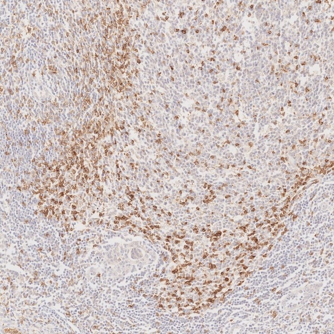 Immunohistochemistry (IHC) staining of human lymphoma tissue using PD-1/CD279 Monoclonal antibody (66220-1-Ig)