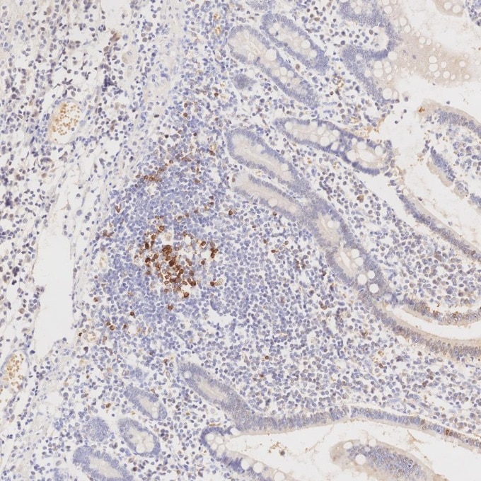 Immunohistochemistry (IHC) staining of human lymphoma tissue using PD-1/CD279 Monoclonal antibody (66220-1-Ig)