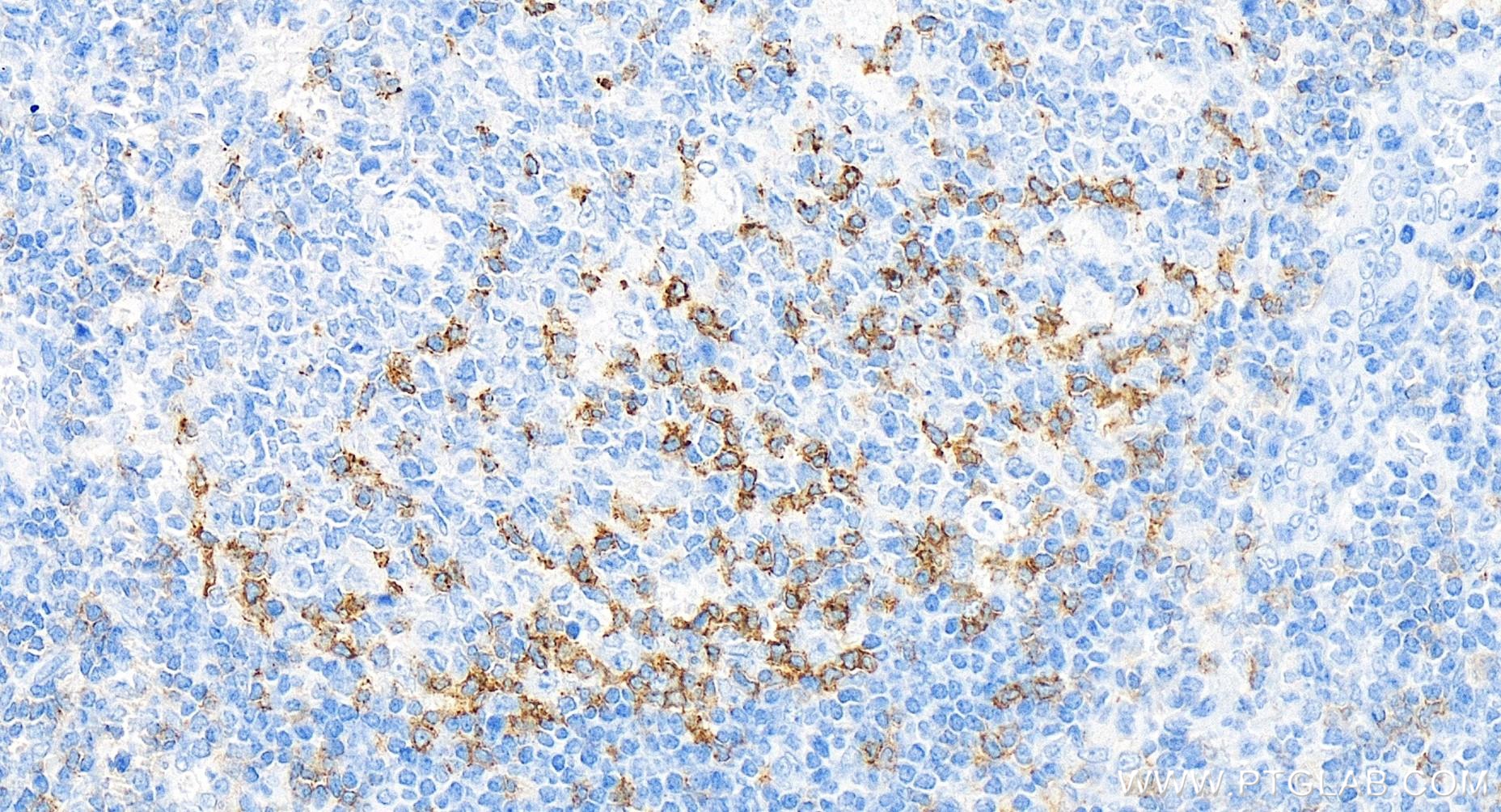 Immunohistochemistry (IHC) staining of human tonsillitis tissue using Anti-Human PD-1/CD279 Rabbit Recombinant Antibody (98068-1-RR)