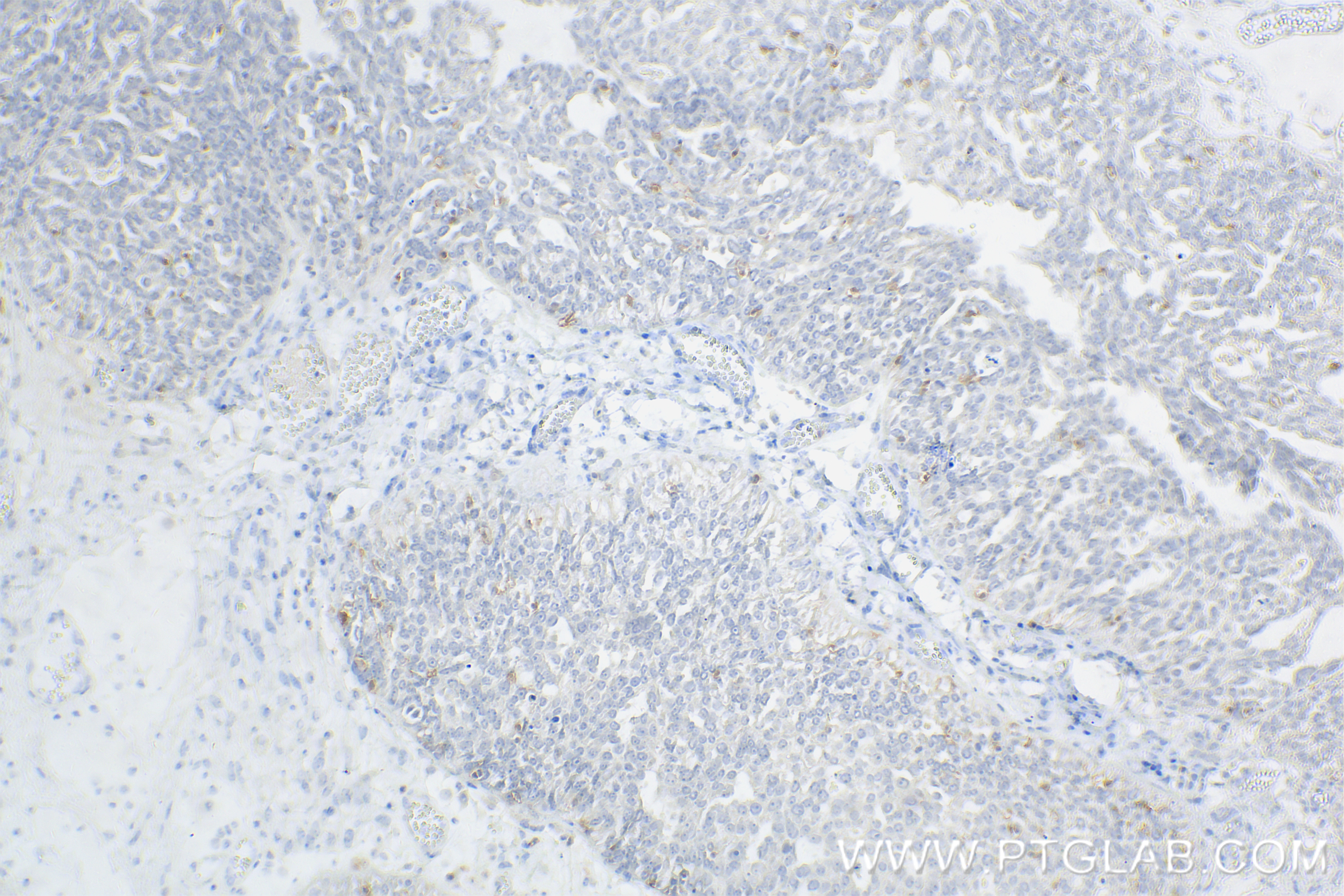 Immunohistochemistry (IHC) staining of human ovary cancer tissue using Anti-Human PD-1/CD279 Rabbit Recombinant Antibody (98068-1-RR)