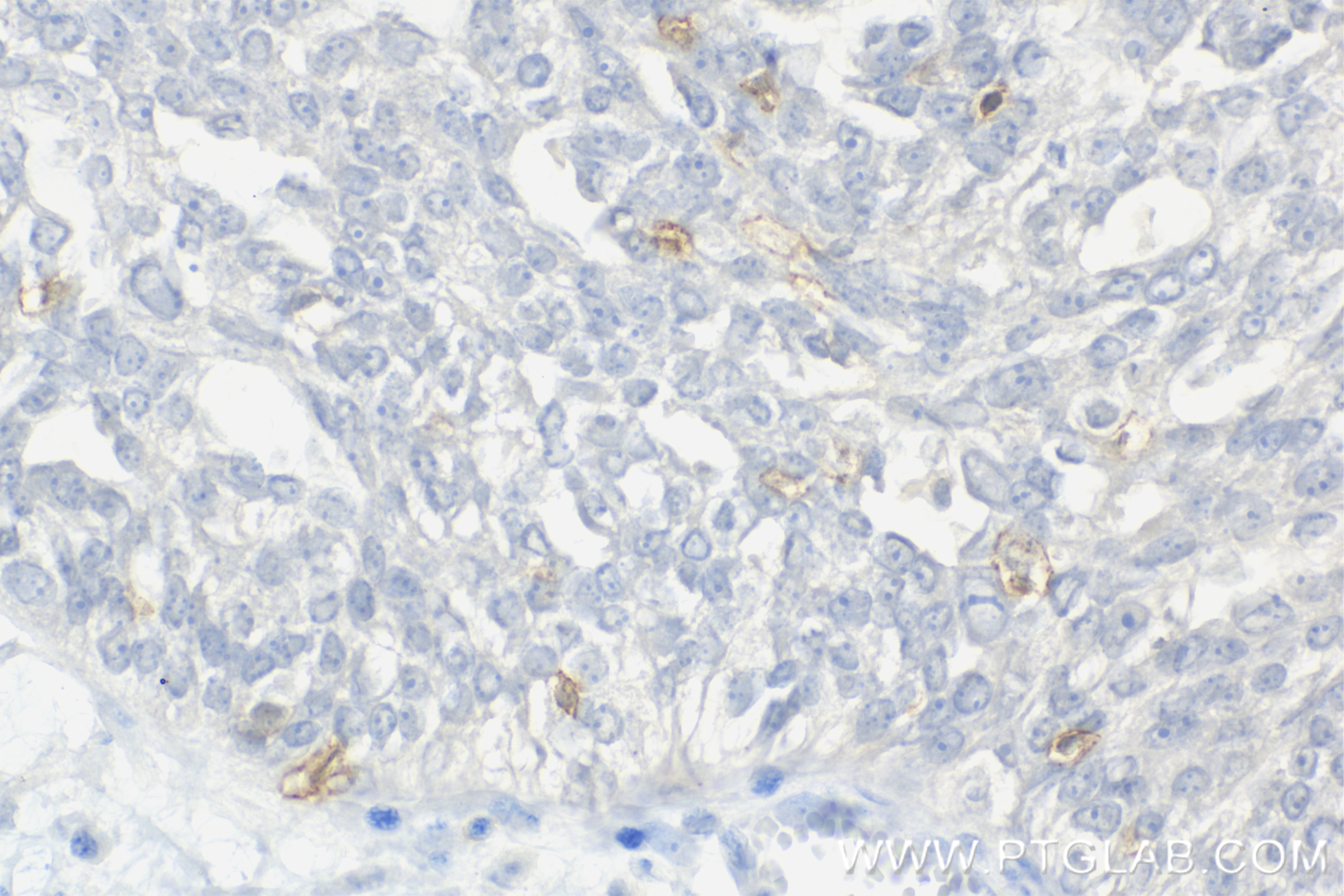 Immunohistochemistry (IHC) staining of human ovary cancer tissue using Anti-Human PD-1/CD279 Rabbit Recombinant Antibody (98068-1-RR)