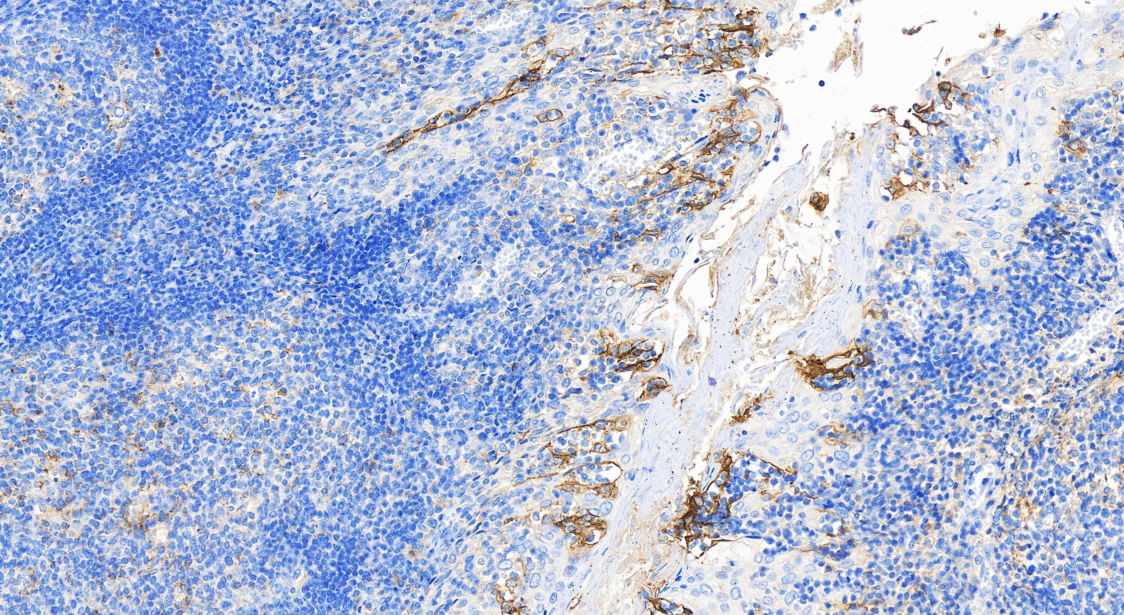 Immunohistochemistry (IHC) staining of human tonsillitis tissue using PD-L1/CD274 Recombinant antibody (82719-13-RR)