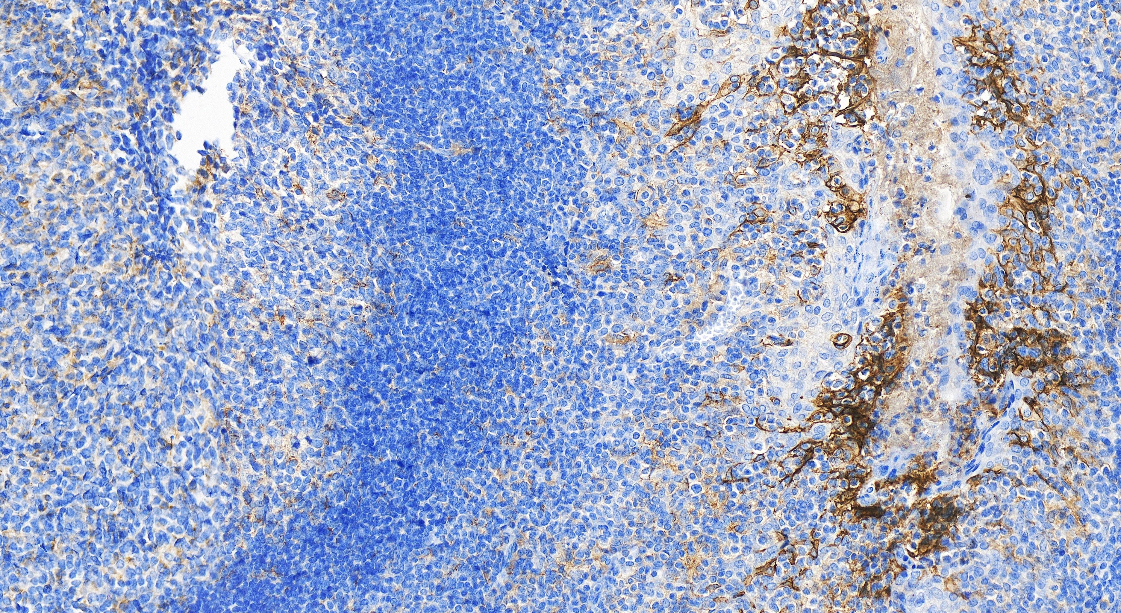 Immunohistochemistry (IHC) staining of human tonsillitis tissue using PD-L1/CD274 Recombinant antibody (82719-13-RR)