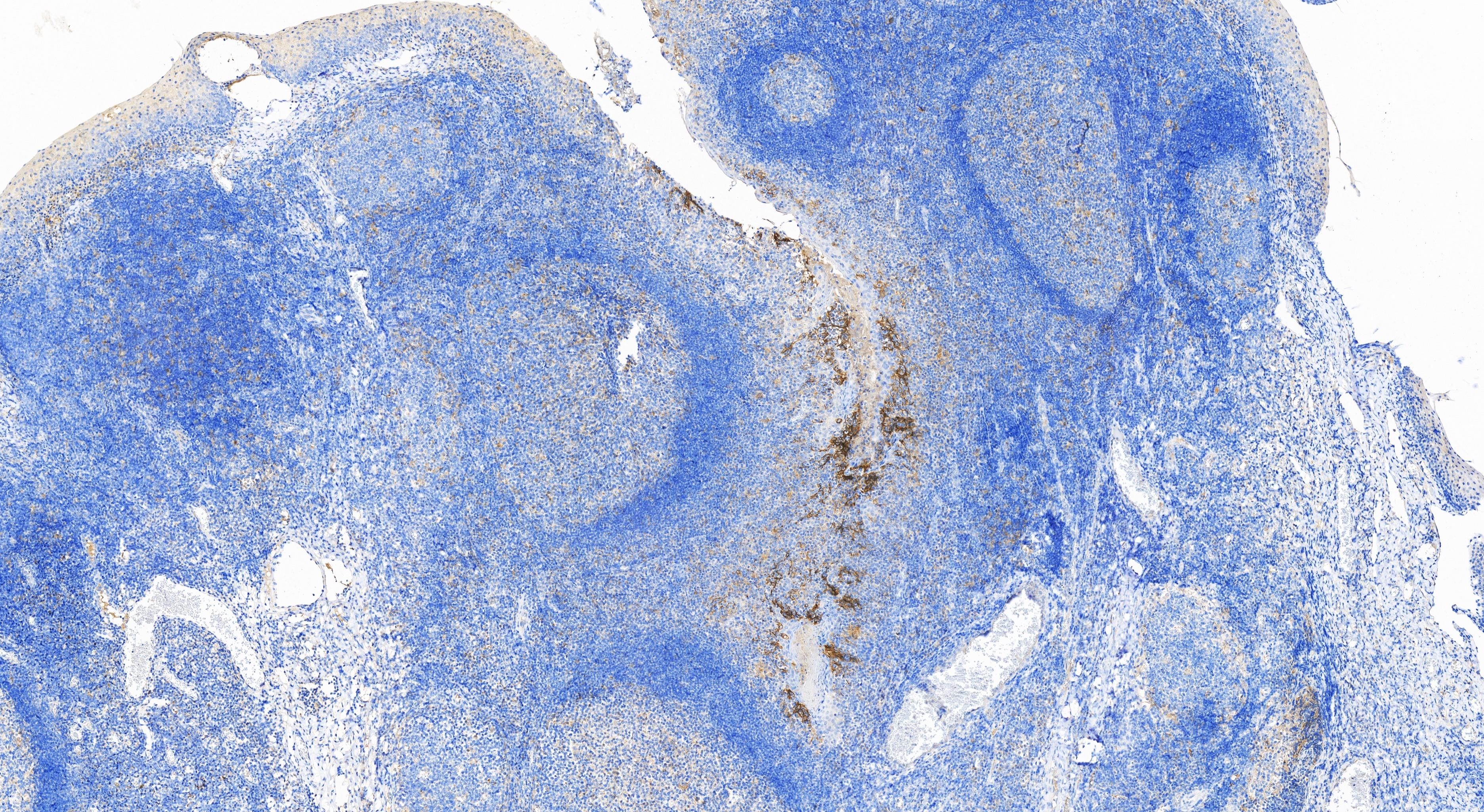 Immunohistochemistry (IHC) staining of human tonsillitis tissue using PD-L1/CD274 Recombinant antibody (82719-13-RR)