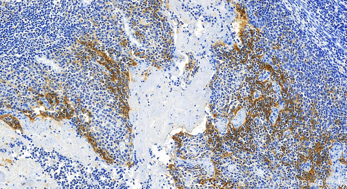 Immunohistochemistry (IHC) staining of human tonsillitis tissue using PD-L1/CD274 Recombinant antibody (82719-15-RR)