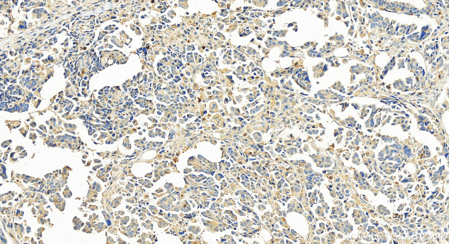 Immunohistochemistry (IHC) staining of human ovary cancer tissue using PDE6A Polyclonal antibody (21200-1-AP)