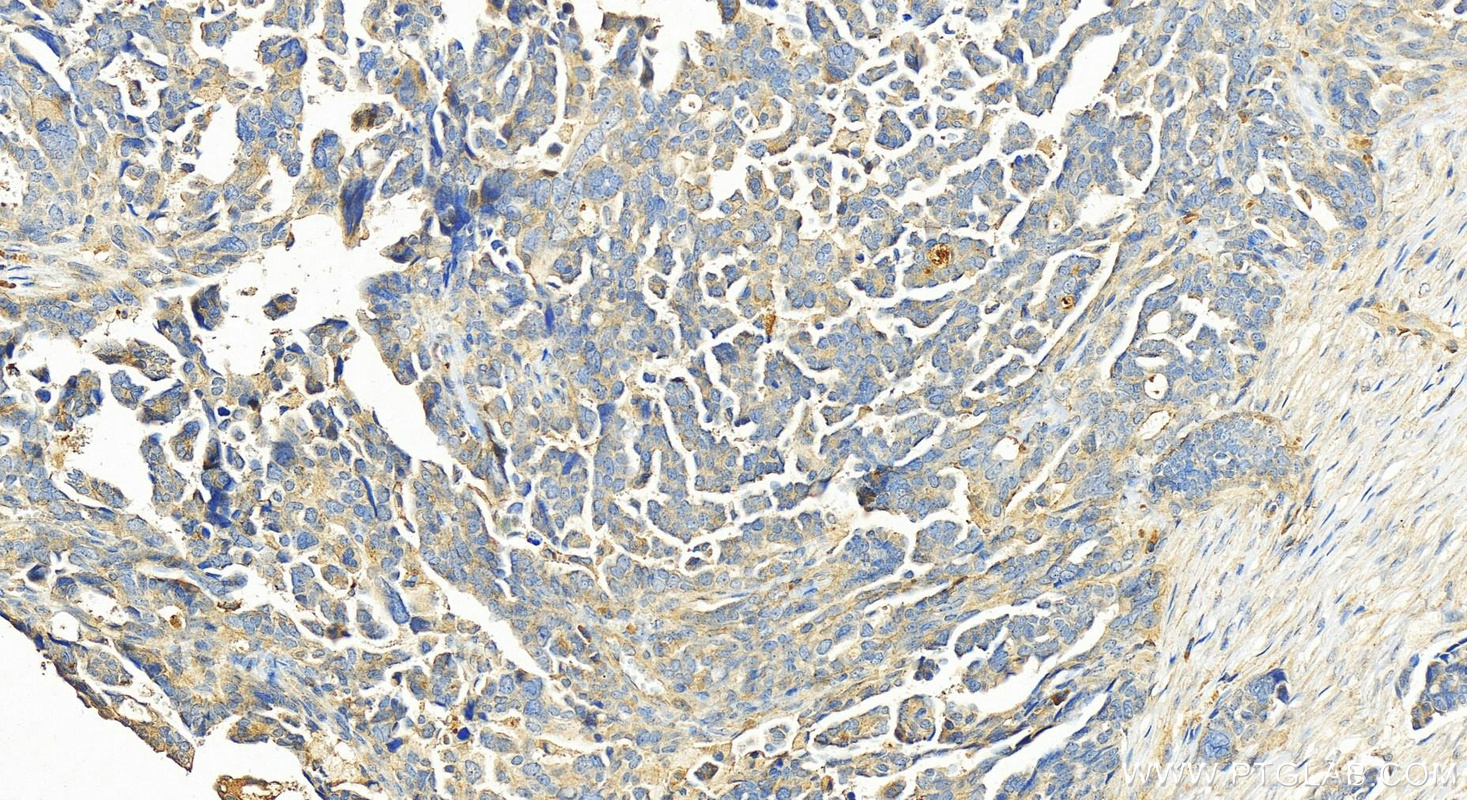 Immunohistochemistry (IHC) staining of human ovary cancer tissue using PDE6A Polyclonal antibody (21200-1-AP)