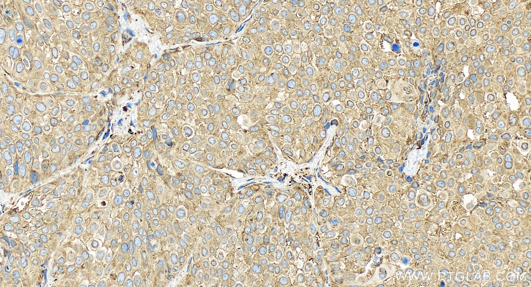 Immunohistochemistry (IHC) staining of human lung cancer tissue using ERp57/ERp60 Recombinant antibody (85087-5-RR)