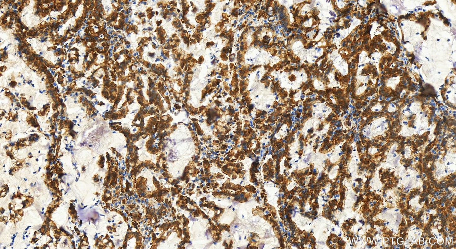 Immunohistochemistry (IHC) staining of human stomach cancer tissue using PDLIM1/CLP36 Polyclonal antibody (11674-1-AP)