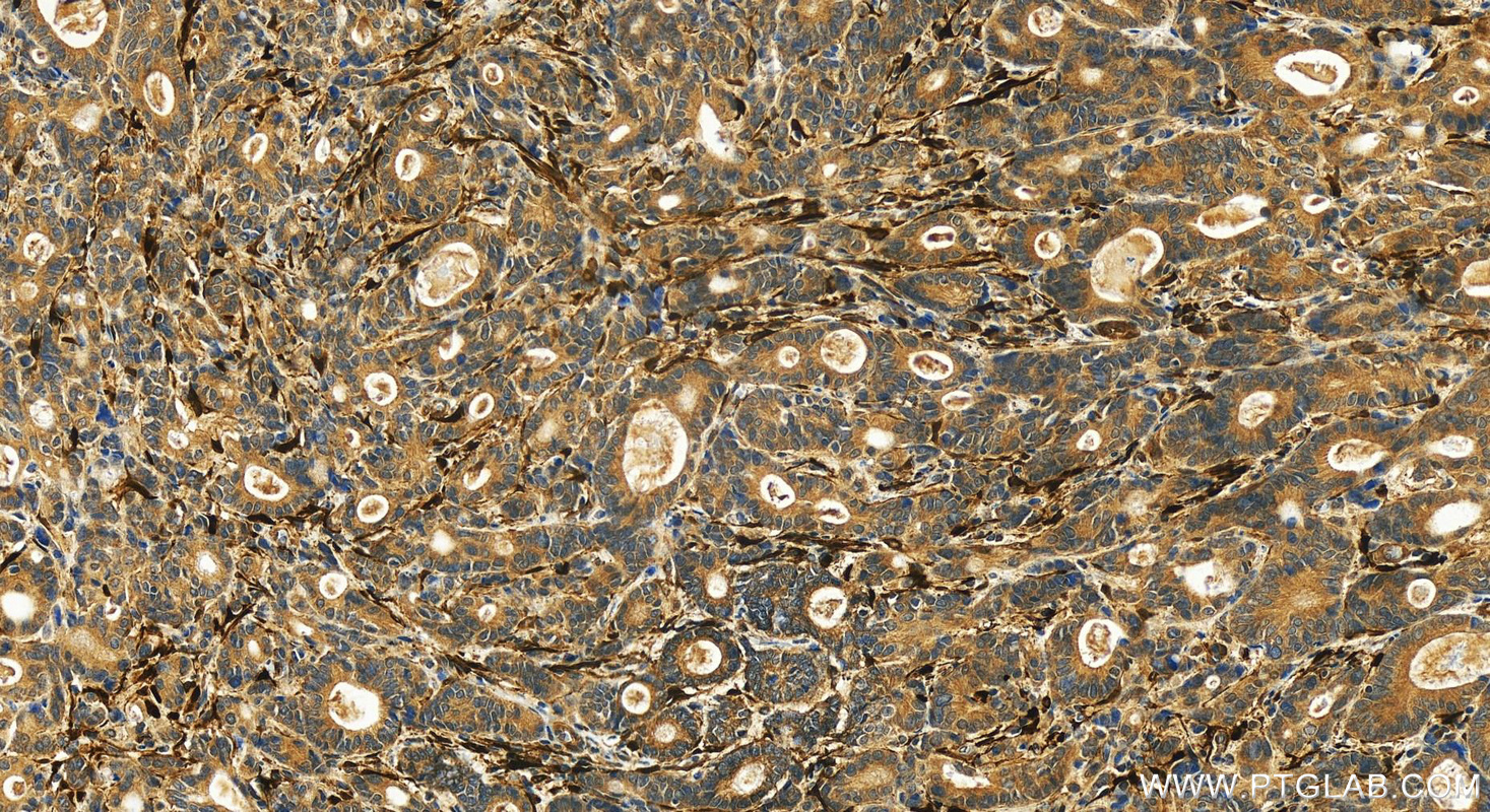 Immunohistochemistry (IHC) staining of human stomach cancer tissue using PDLIM3 Polyclonal antibody (13199-2-AP)