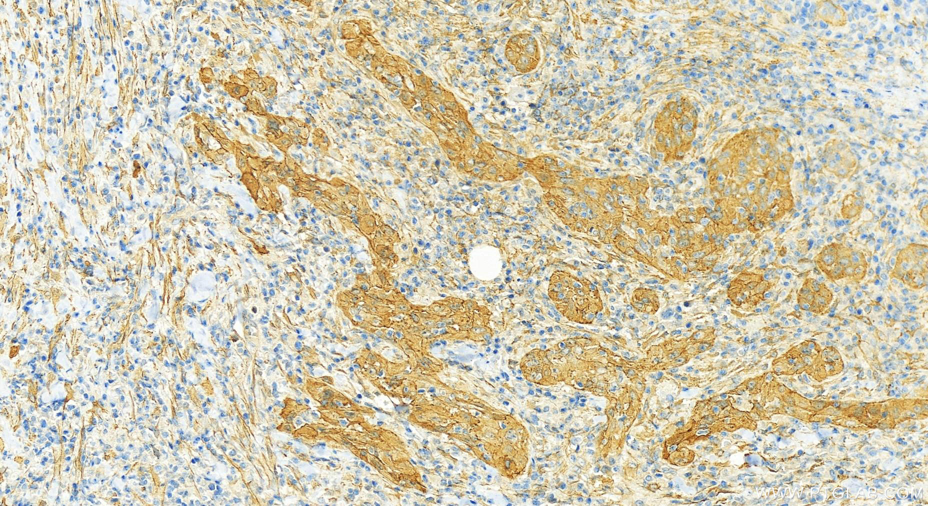 Immunohistochemistry (IHC) staining of human skin cancer tissue using PDLIM4 Polyclonal antibody (18543-1-AP)