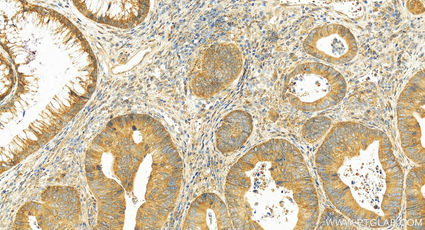 Immunohistochemistry (IHC) staining of human colon cancer tissue using RKIP Polyclonal antibody (10575-1-AP)