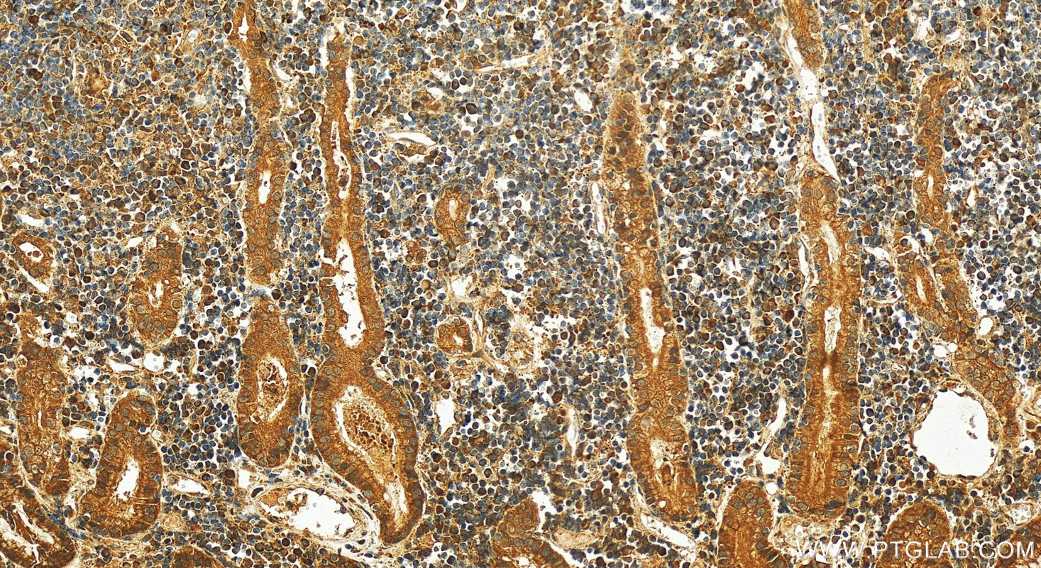 Immunohistochemistry (IHC) staining of human stomach cancer tissue using RKIP Polyclonal antibody (10575-1-AP)