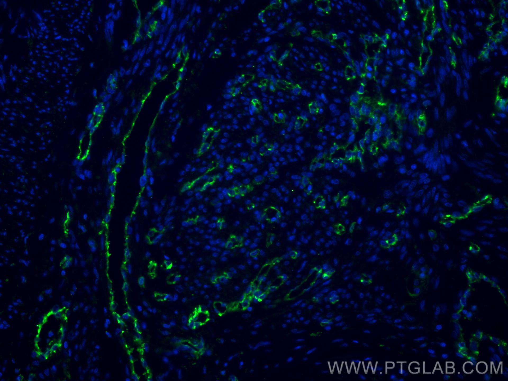 Immunofluorescence (IF) / fluorescent staining of human endometrial cancer tissue using CD31 Polyclonal antibody (11265-1-AP)