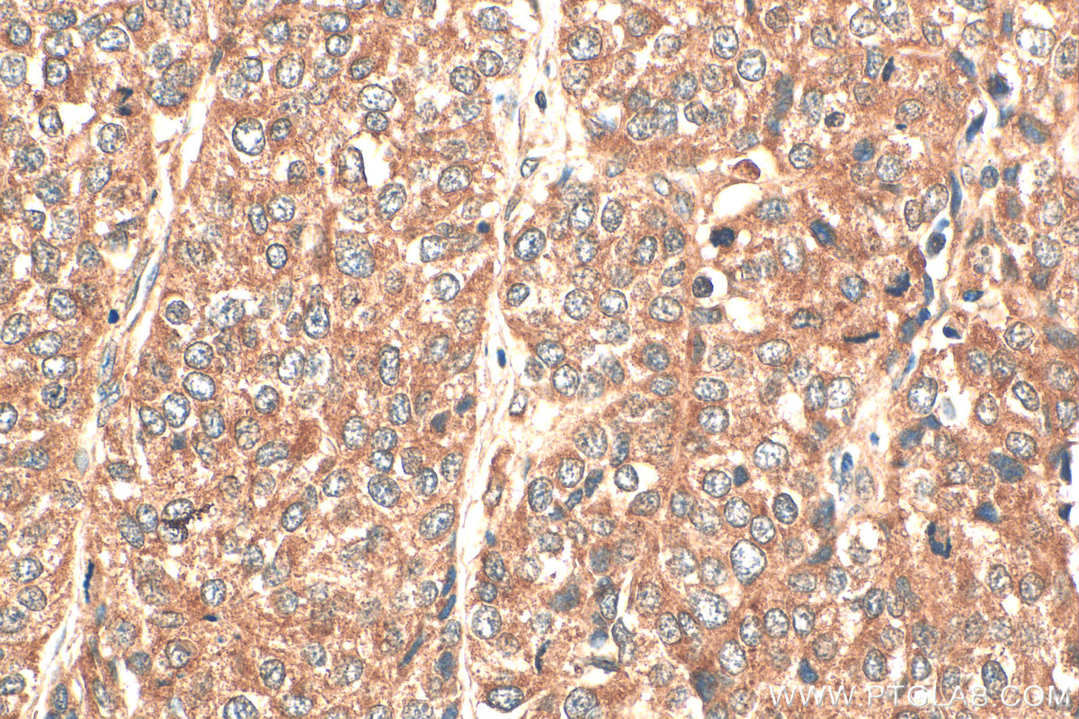 Immunohistochemistry (IHC) staining of human stomach cancer tissue using PFKFB3 Polyclonal antibody (13763-1-AP)