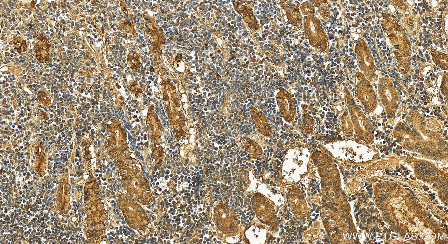 Immunohistochemistry (IHC) staining of human stomach cancer tissue using Pepsinogen II Polyclonal antibody (16881-1-AP)