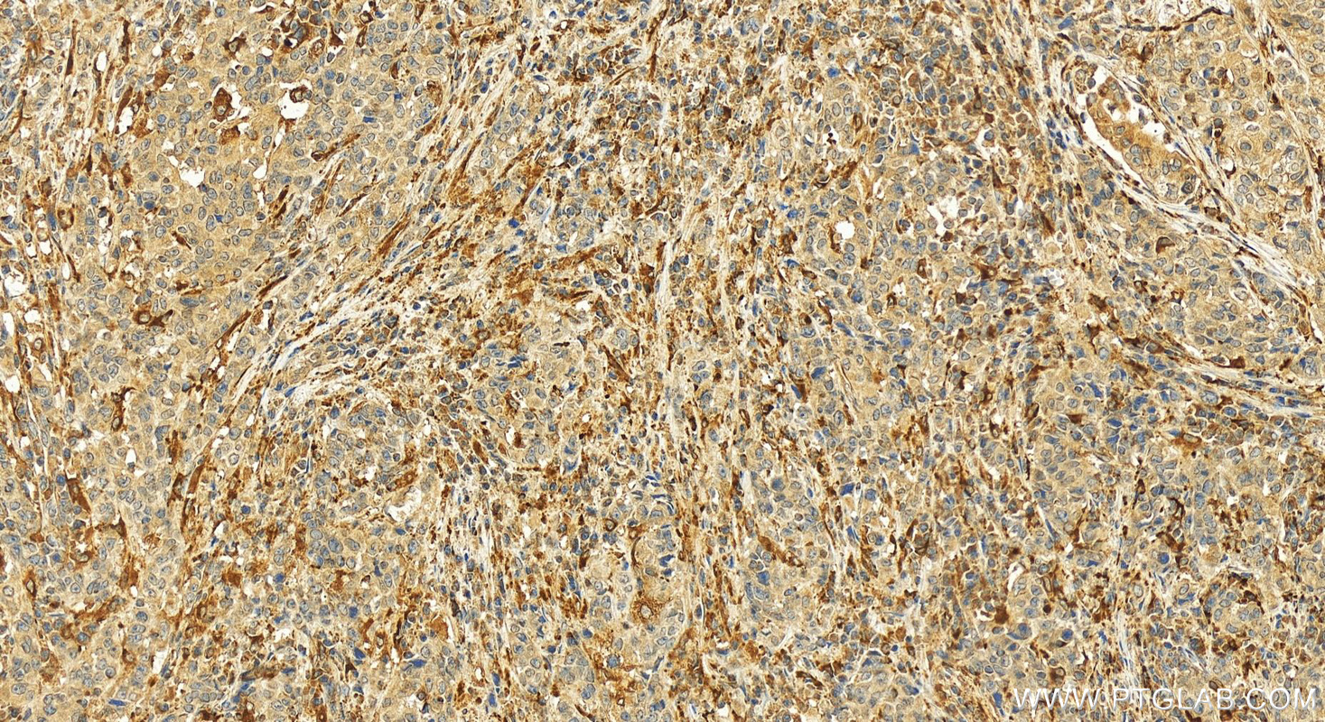 Immunohistochemistry (IHC) staining of human stomach cancer tissue using Pepsinogen II Polyclonal antibody (16881-1-AP)