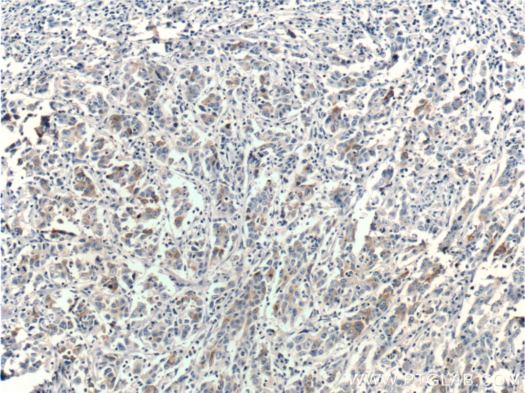 Immunohistochemistry (IHC) staining of human stomach cancer tissue using PGC Monoclonal antibody (67849-1-Ig)