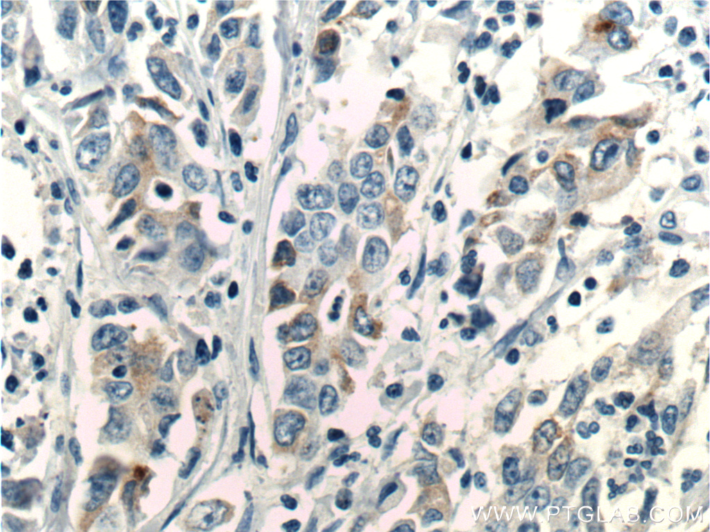 Immunohistochemistry (IHC) staining of human stomach cancer tissue using PGC Monoclonal antibody (67849-1-Ig)