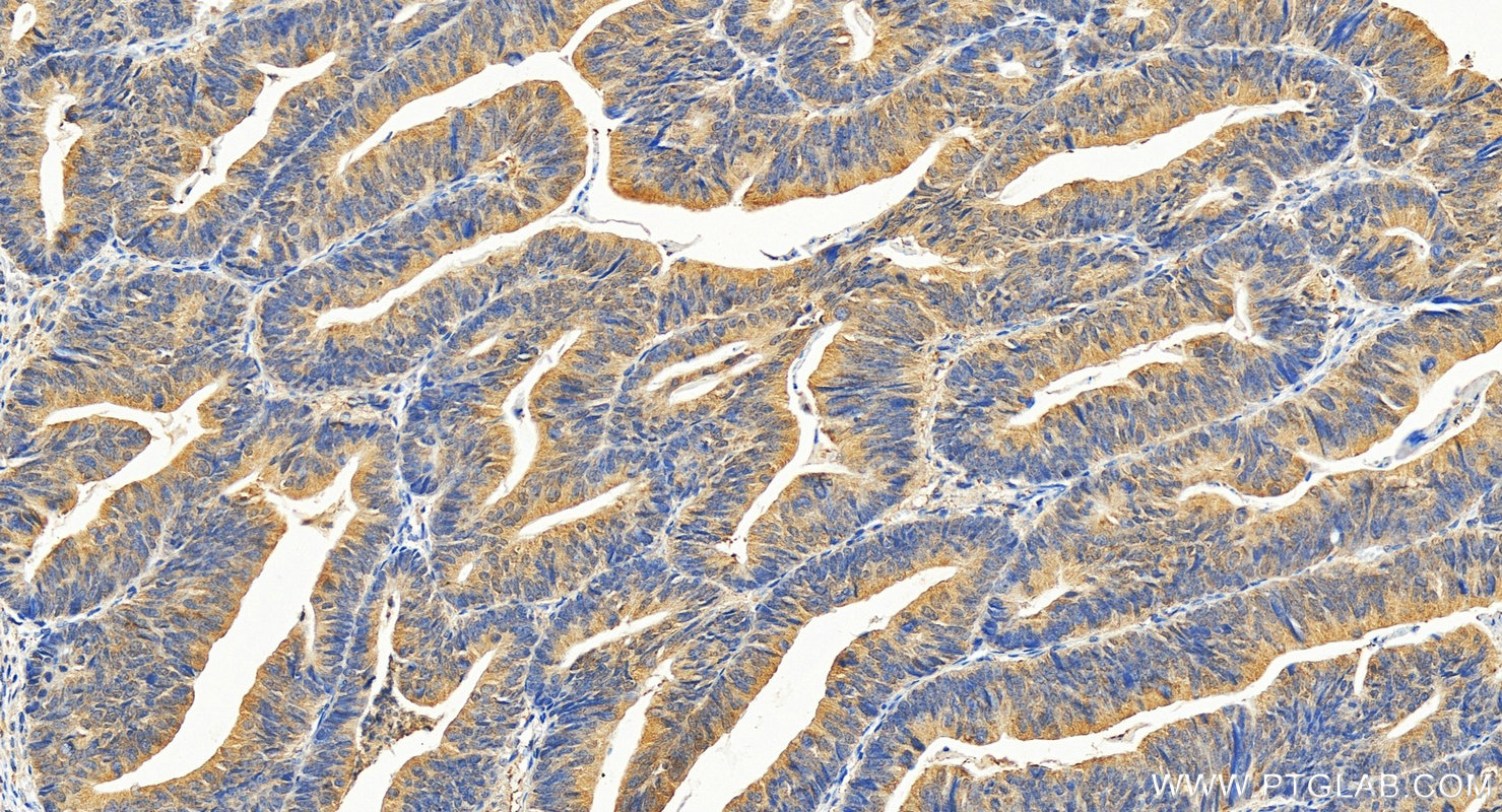 Immunohistochemistry (IHC) staining of human colon cancer tissue using PGK1 Polyclonal antibody (17811-1-AP)