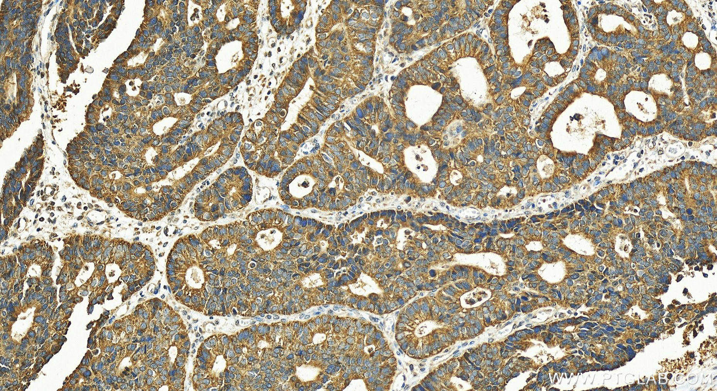 Immunohistochemistry (IHC) staining of human stomach cancer tissue using PGT Polyclonal antibody (30434-1-AP)