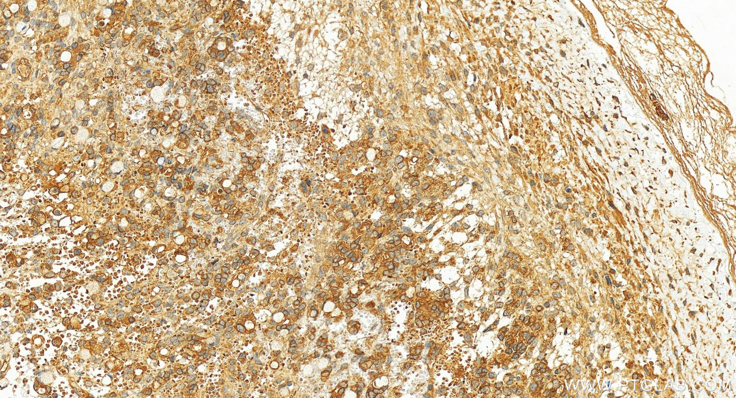 Immunohistochemistry (IHC) staining of human ovary cancer tissue using PHACTR4 Polyclonal antibody (13408-1-AP)