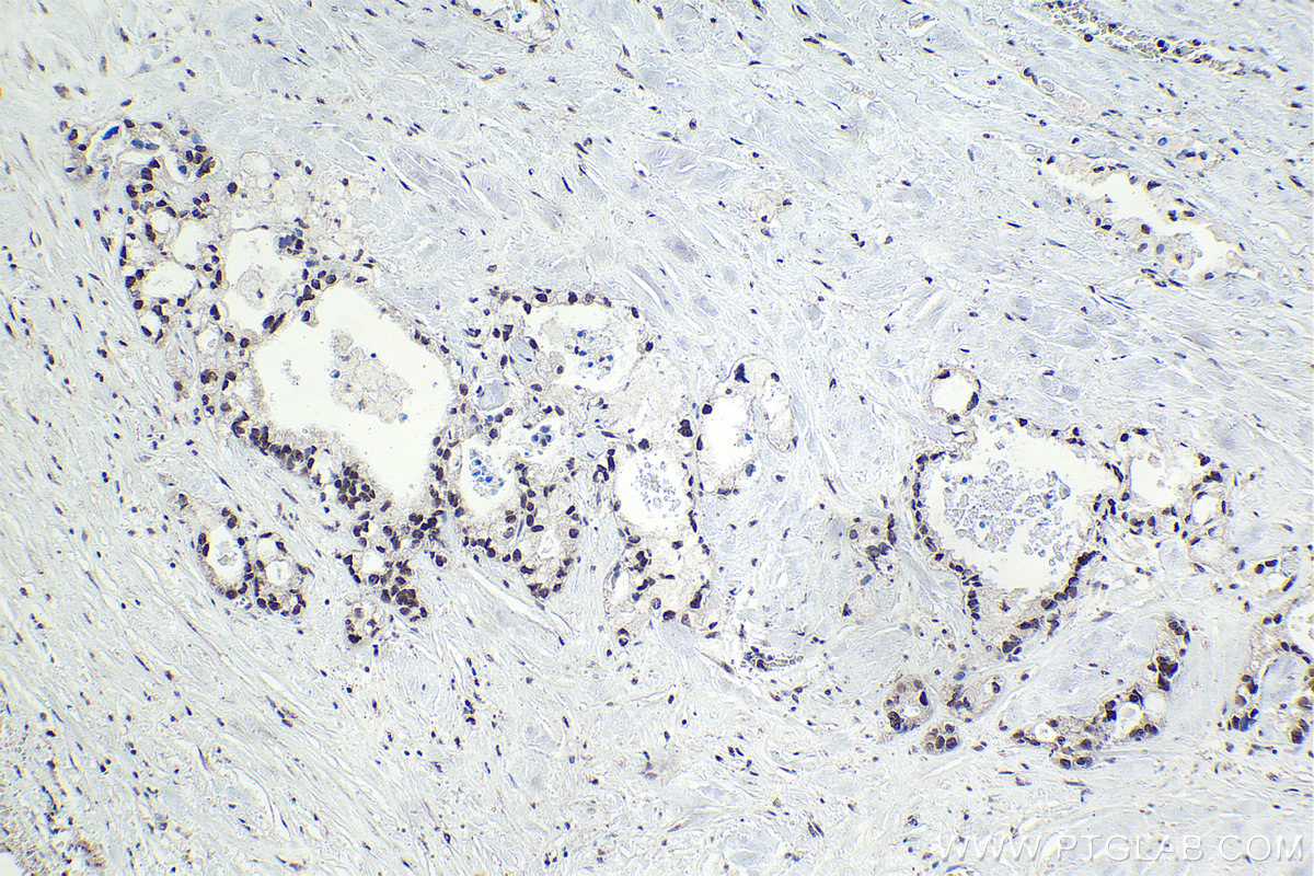 Immunohistochemistry (IHC) staining of human pancreas cancer tissue using PHC2 Polyclonal antibody (12867-1-AP)