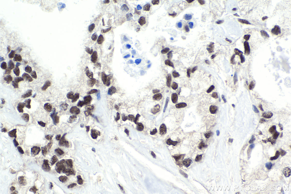 Immunohistochemistry (IHC) staining of human pancreas cancer tissue using PHC2 Polyclonal antibody (12867-1-AP)