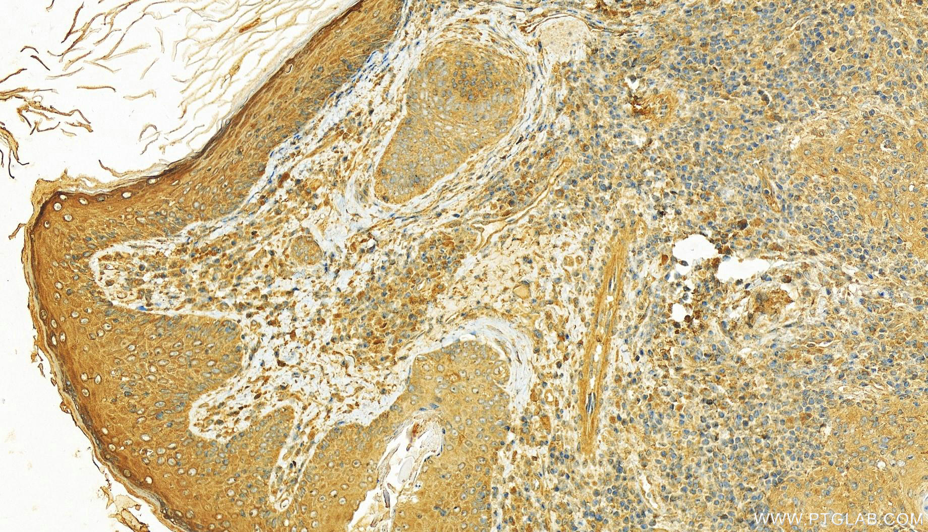 Immunohistochemistry (IHC) staining of human skin cancer tissue using PHLDB2 Polyclonal antibody (27940-1-AP)