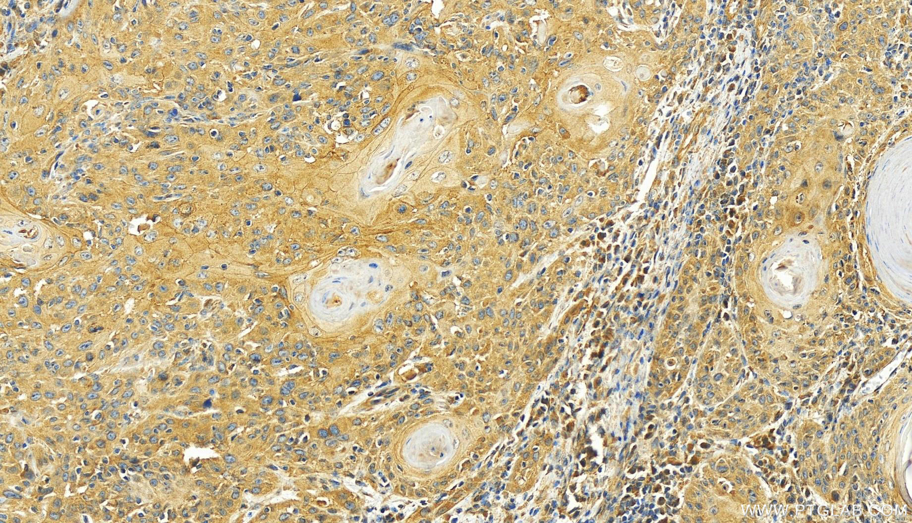 Immunohistochemistry (IHC) staining of human skin cancer tissue using PHLDB2 Polyclonal antibody (27940-1-AP)