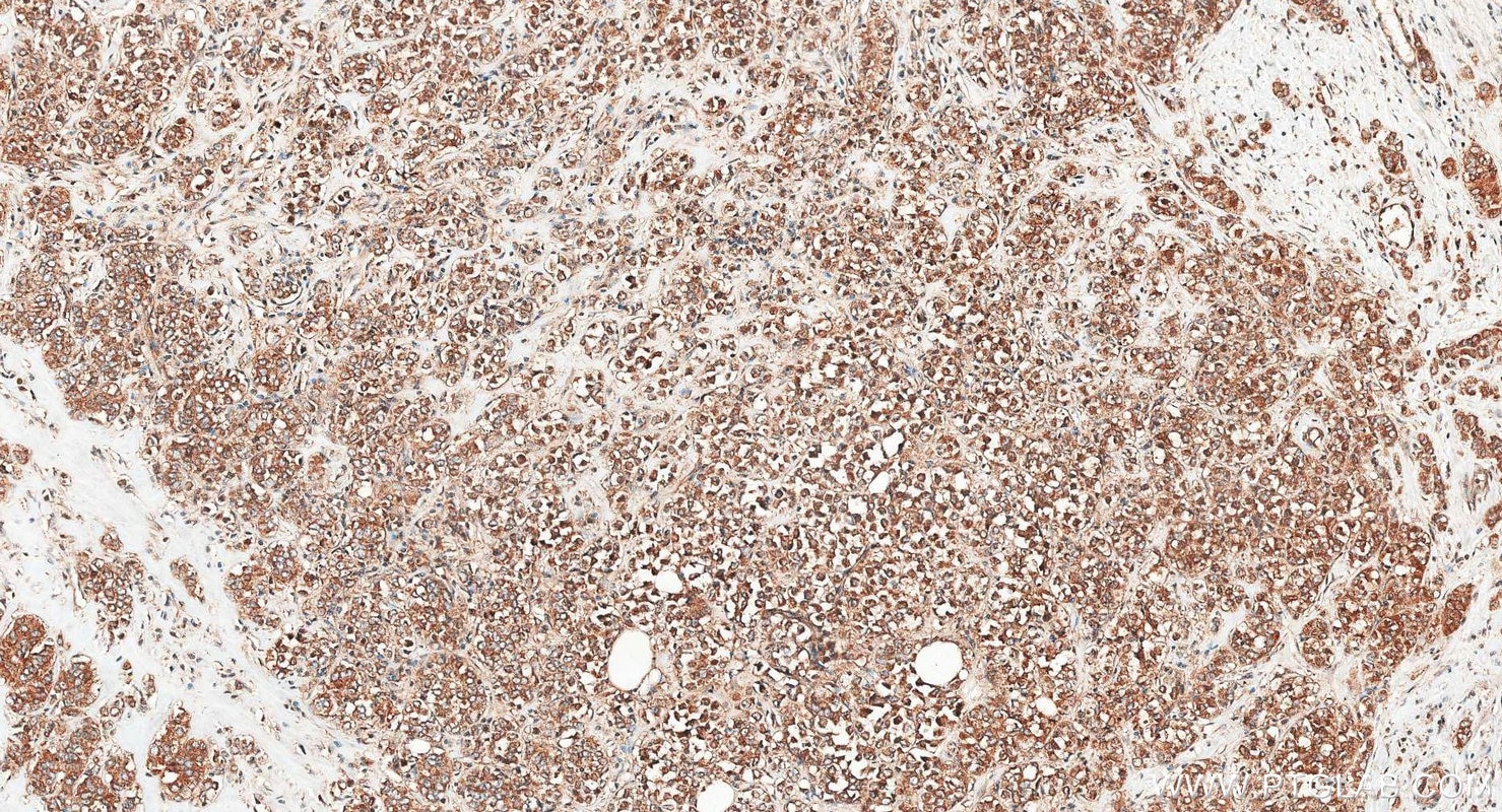 Immunohistochemistry (IHC) staining of human breast cancer tissue using PI3 Kinase p110 Alpha Polyclonal antibody (27921-1-AP)