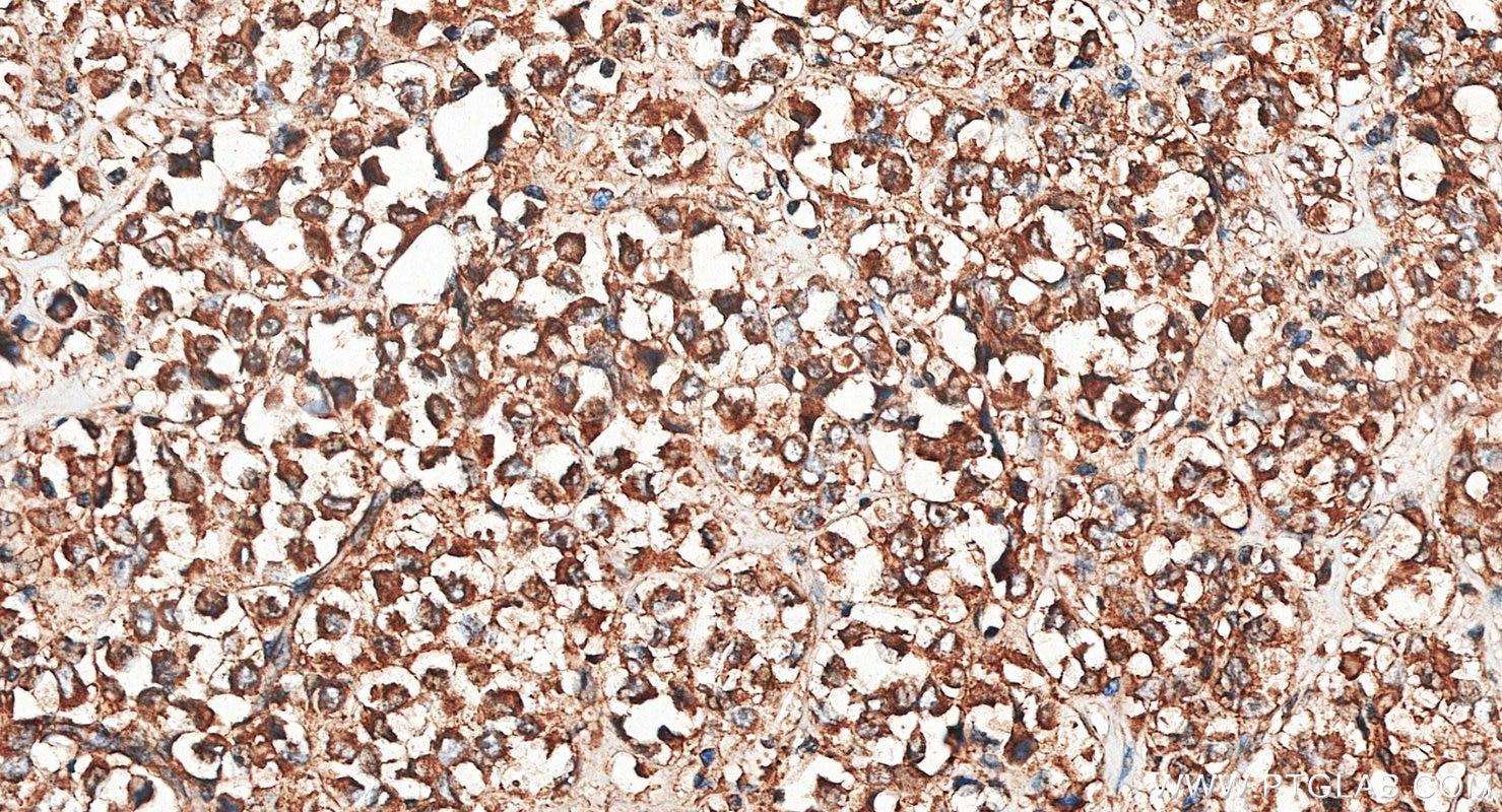 Immunohistochemistry (IHC) staining of human breast cancer tissue using PI3 Kinase p110 Alpha Polyclonal antibody (27921-1-AP)