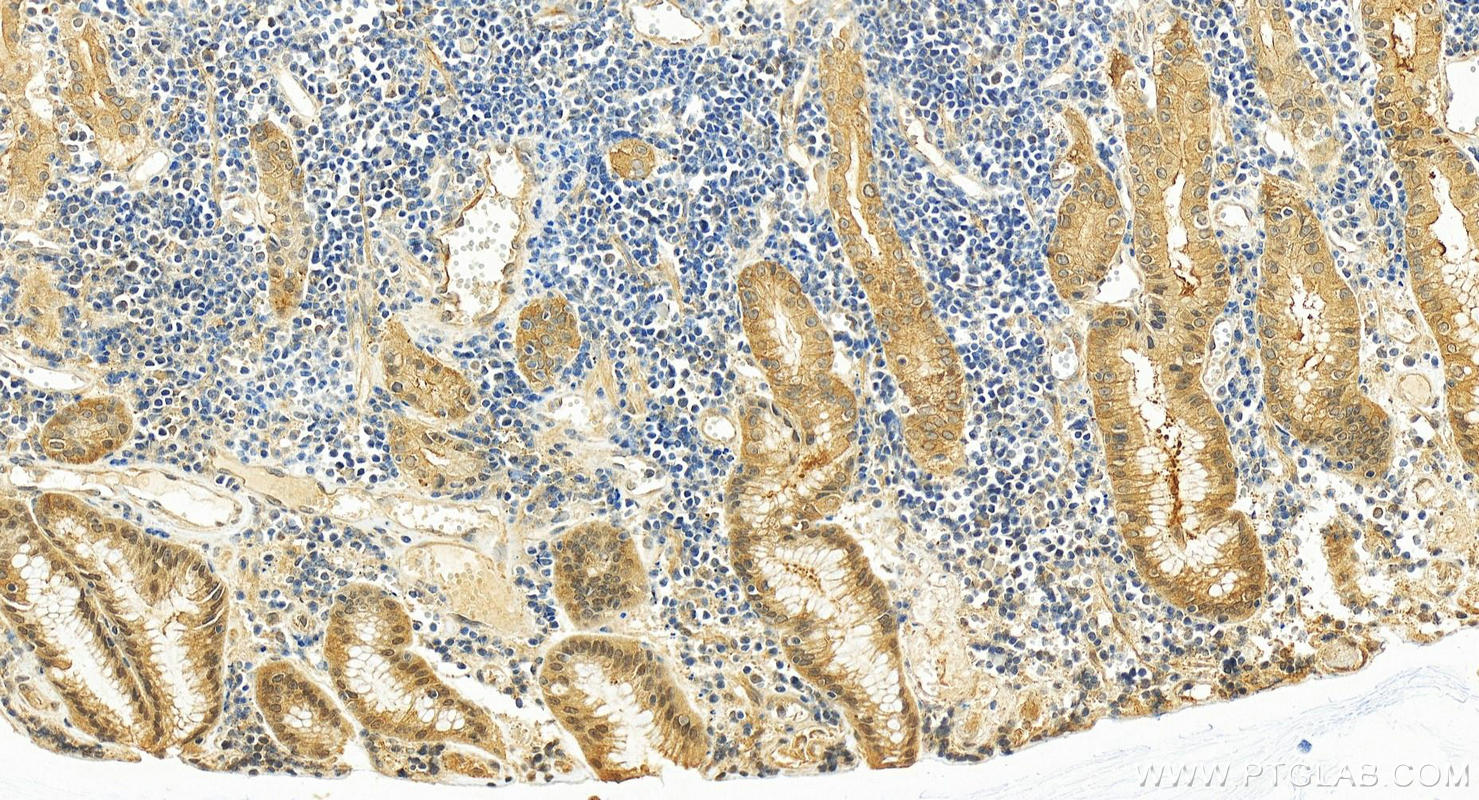 Immunohistochemistry (IHC) staining of human stomach cancer tissue using PICK1 Recombinant antibody (82919-1-RR)