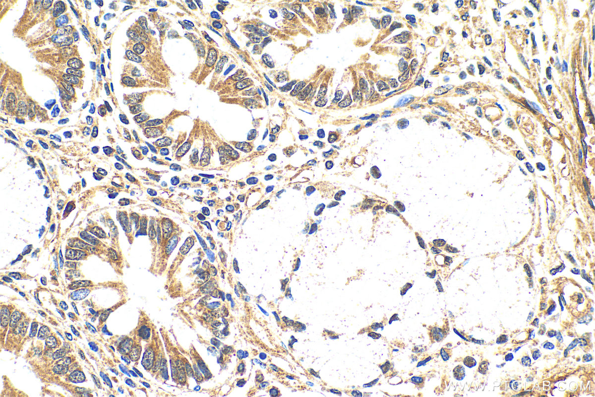 Immunohistochemistry (IHC) staining of human stomach cancer tissue using PICK1 Recombinant antibody (82919-1-RR)