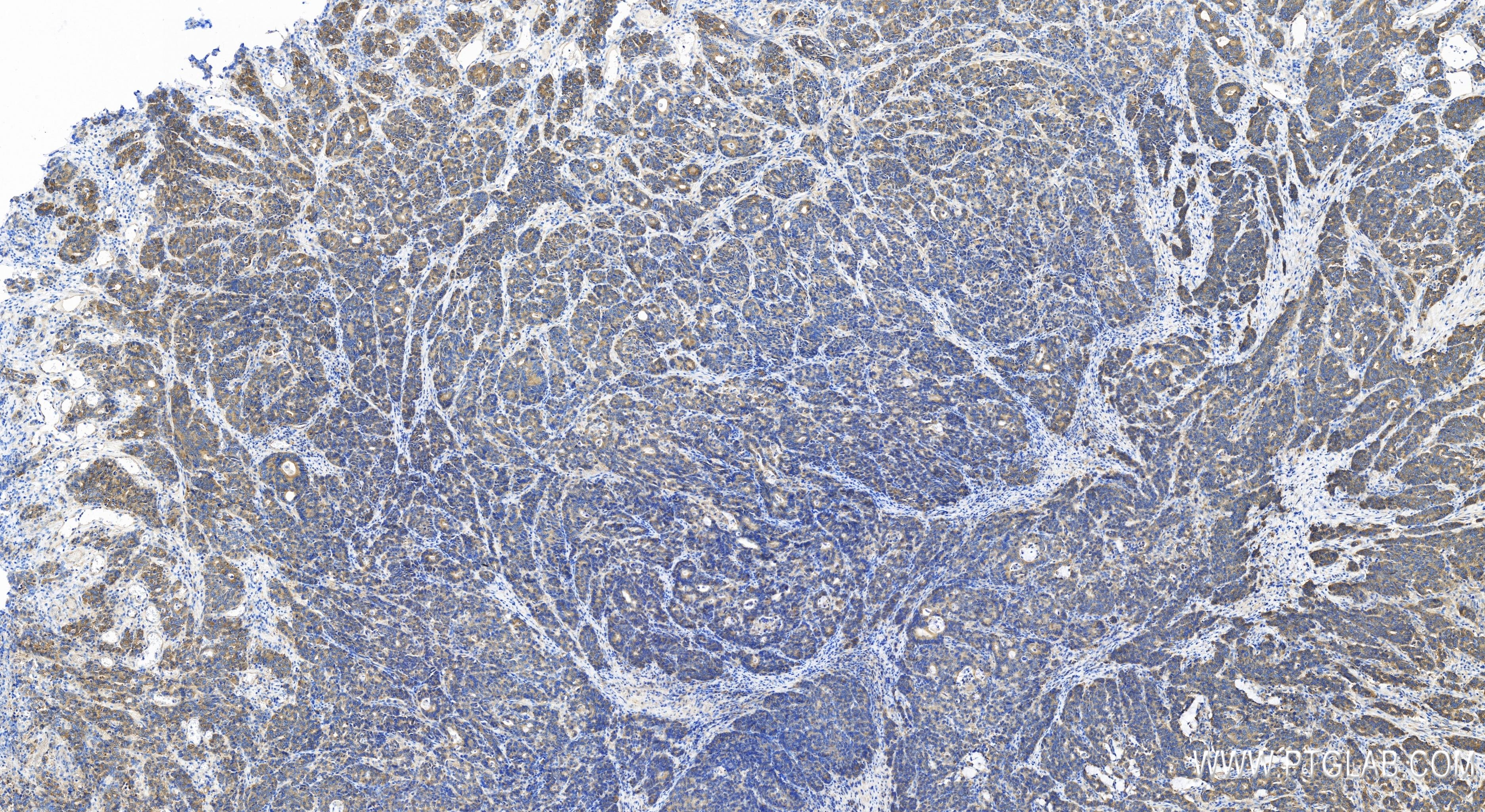 Immunohistochemistry (IHC) staining of human stomach cancer tissue using PICK1 Recombinant antibody (82919-1-RR)