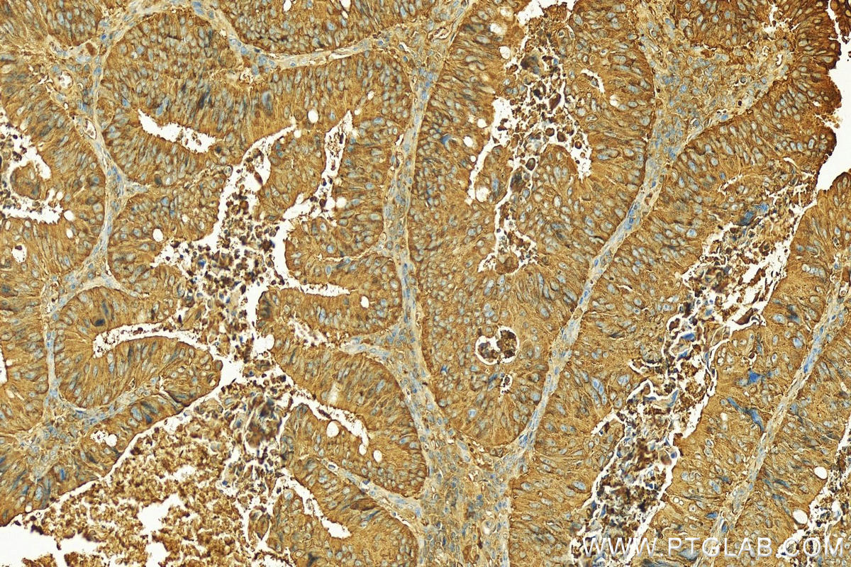 Immunohistochemistry (IHC) staining of human colon cancer tissue using PIGR Polyclonal antibody (22024-1-AP)