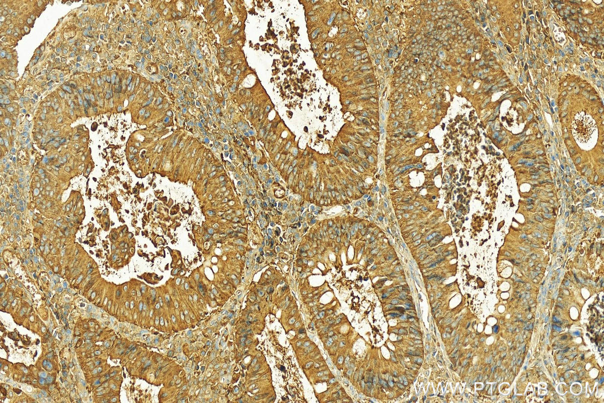 Immunohistochemistry (IHC) staining of human colon cancer tissue using PIGR Polyclonal antibody (22024-1-AP)