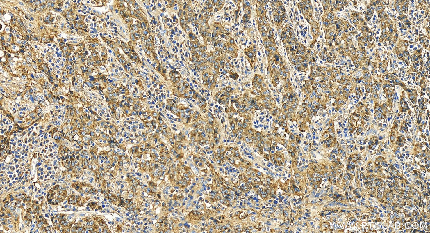 Immunohistochemistry (IHC) staining of human stomach cancer tissue using PIGR Polyclonal antibody (22024-1-AP)