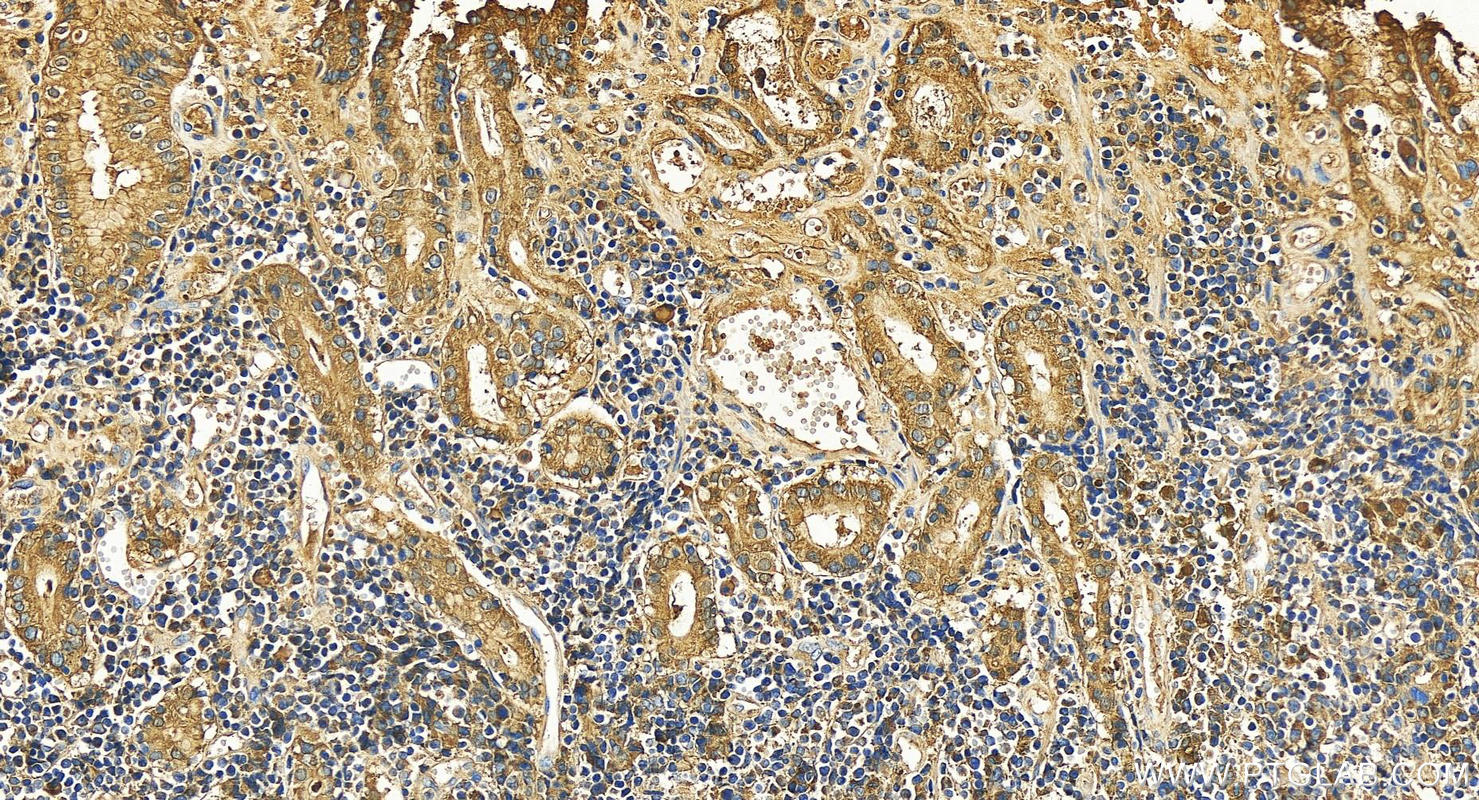 Immunohistochemistry (IHC) staining of human stomach cancer tissue using PIGR Polyclonal antibody (22024-1-AP)