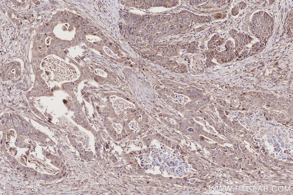 Immunohistochemistry (IHC) staining of human stomach cancer tissue using PI3 Kinase p55 Gamma Polyclonal antibody (27035-1-AP)