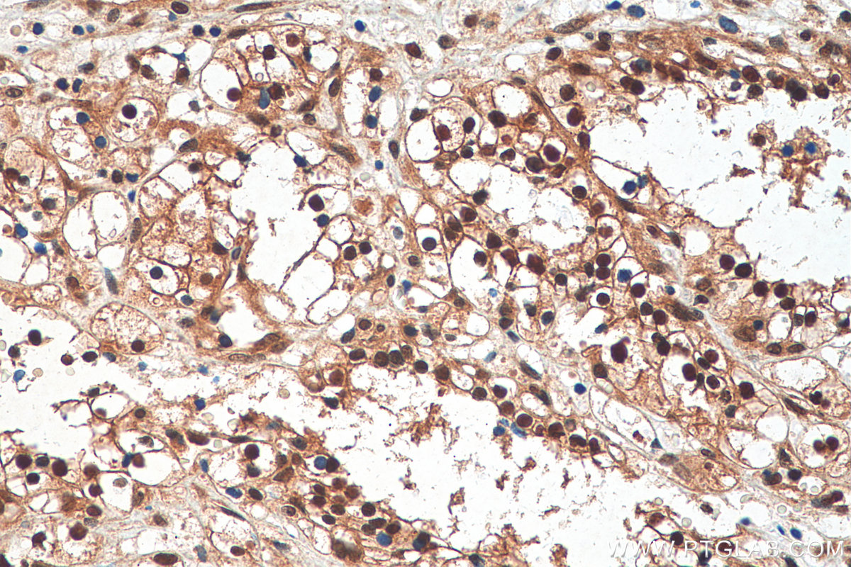 Immunohistochemistry (IHC) staining of human renal cell carcinoma tissue using PIN1 Polyclonal antibody (10495-1-AP)