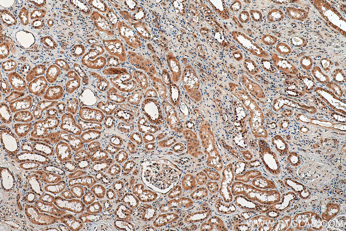 Immunohistochemistry (IHC) staining of human renal cell carcinoma tissue using PIN1 Polyclonal antibody (10495-1-AP)